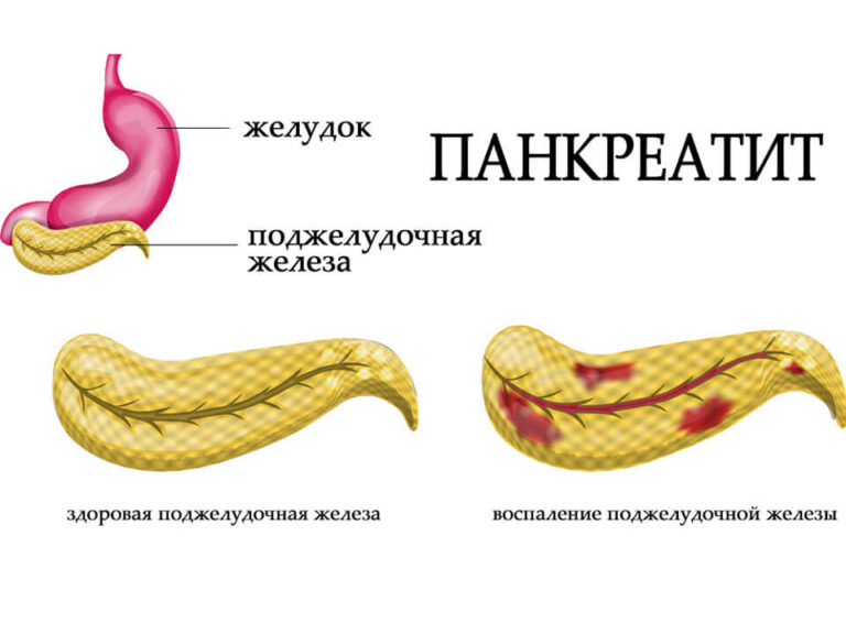 Хронический поджелудочной железы. Фибролипоматоз поджелудочной железы что это такое. Острый и хронический панкреатит. Панкреатит поджелудочной железы. Острый панкреатит поджелудочной железы.